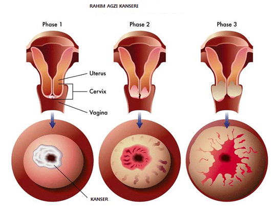 Rahim Az Kanseri Neden Olur